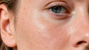 Gros plan sur une peau sèche du visage présentant des tiraillements et des squames visibles